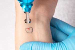 laser tattoo removal middlesborough