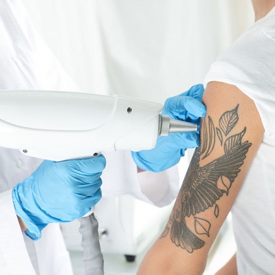 laser tattoo removal at Emporium Salon Middlesbrough