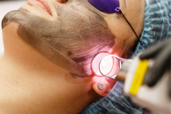 carbon laser facials in Middlesbrough