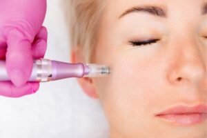 RF Microneedling Middlesbrough